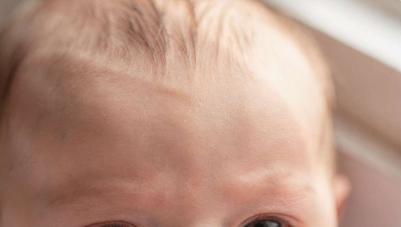3 conseils pour éliminer les boutons sur le cuir chevelu de bébé